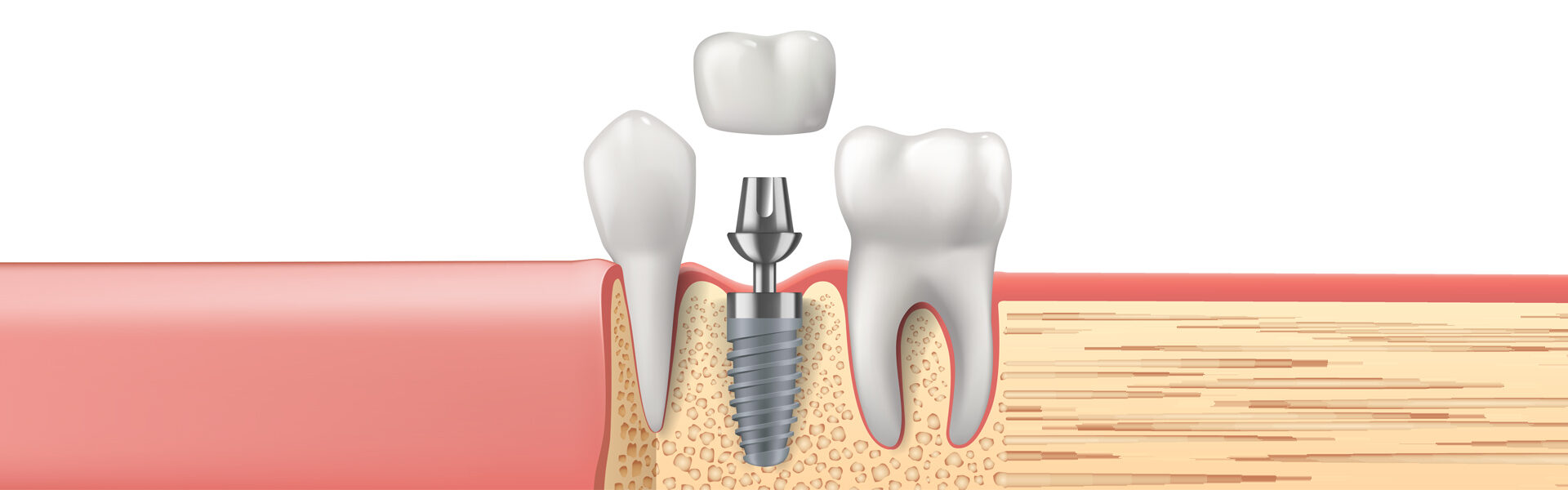 Dental Implants in Saint Paul, MN