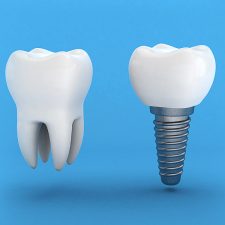 Dental Implants: Procedure, Risks, and Benefits