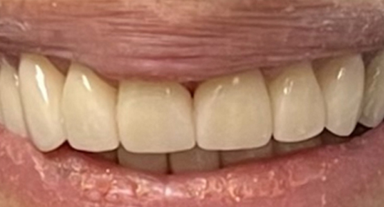 After-Dental crowns for cracked tooth