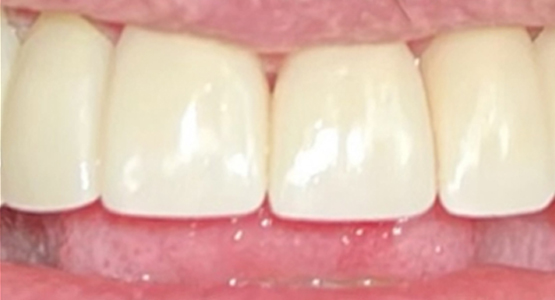 After-Dental crown for broken tooth