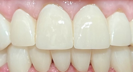 After-Dental crowns