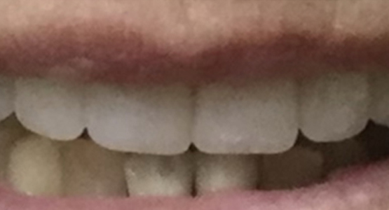 After-Dental crowns for chipped tooth