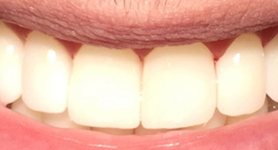 After-Dental crowns at Little Canada Dental