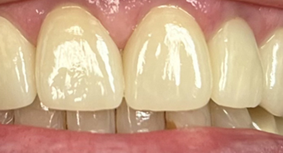 After-Porcelain crowns in St Paul