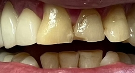 Before-Dental crown for broken tooth