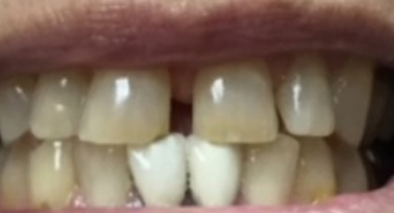 Before-Dental crowns for chipped tooth