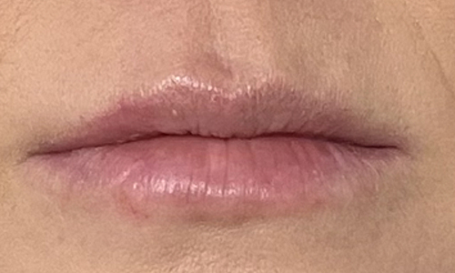 After-lip filler near you