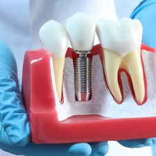 Dental Implants: Bone Graft Healing Stages