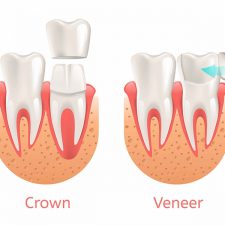 Dental Veneers versus Dental Crowns: An In-depth Comparison