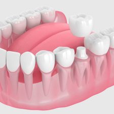 Dental Crown and Bite Problems: How to Solve Them