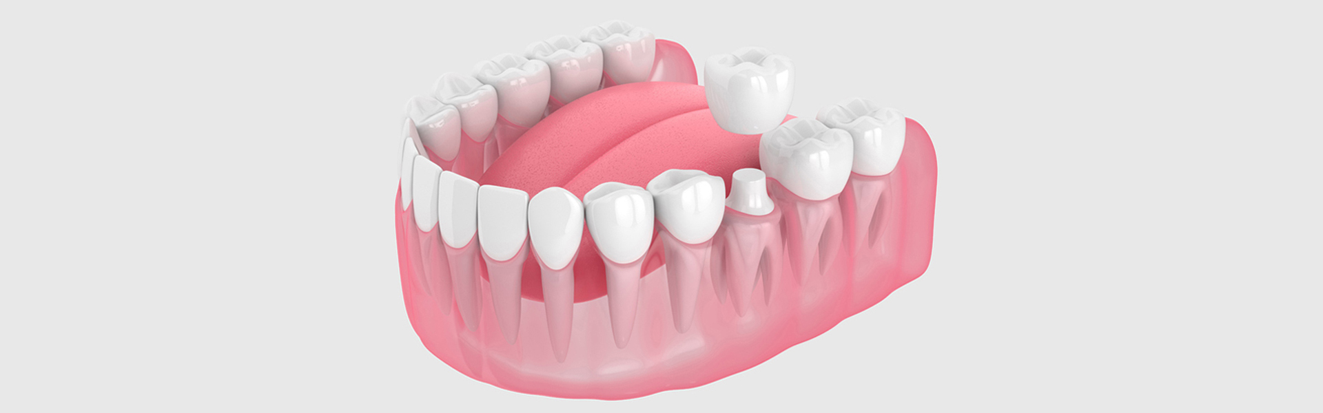 Dental Crown and Bite Problems: How to Solve Them