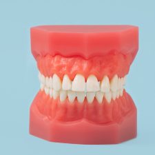 How Dental Implants Dentures Can Improve Your Quality of Life