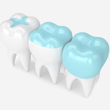 From Placement to Longevity: How Long Do Composite Fillings Last?