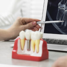 From Surgery to Smile: The Healing Stages of Dental Implants