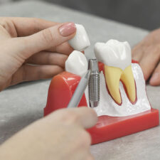 How Long Do Dental Implants Last? Tips to Maximize Their Lifespan