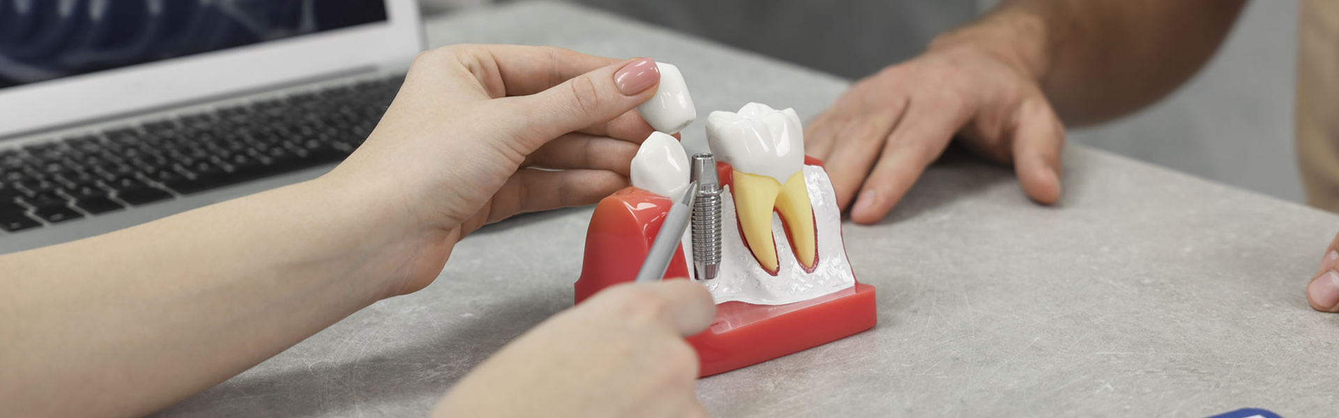 How Long Do Dental Implants Last? Tips to Maximize Their Lifespan