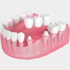 When Is a Dental Bridge the Right Choice for Missing Teeth?