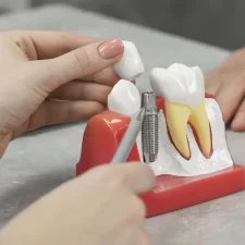 What to Expect During the Dental Implant Process